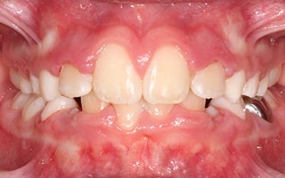 Closeup of flawless smile after cosmetic treatment