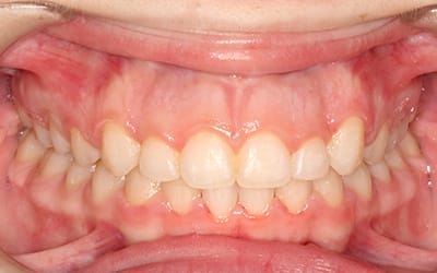 Closeup of flawless smile after cosmetic treatment