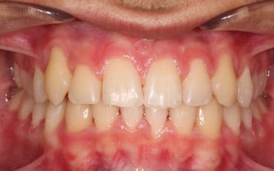 Closeup of flawless smile after cosmetic treatment