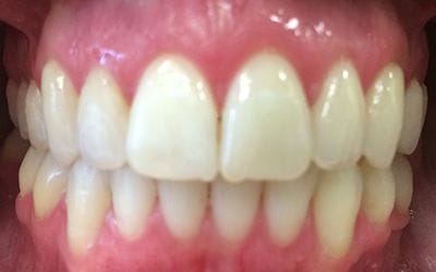 Closeup of flawless smile after cosmetic treatment