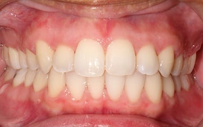 Closeup of flawless smile after cosmetic treatment