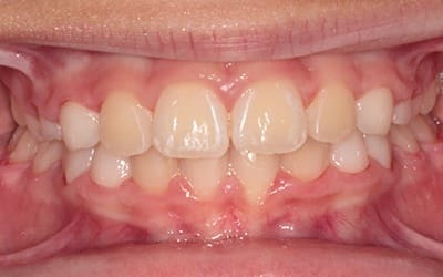 Closeup of flawless smile after cosmetic treatment