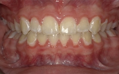 Closeup of flawless smile after cosmetic treatment