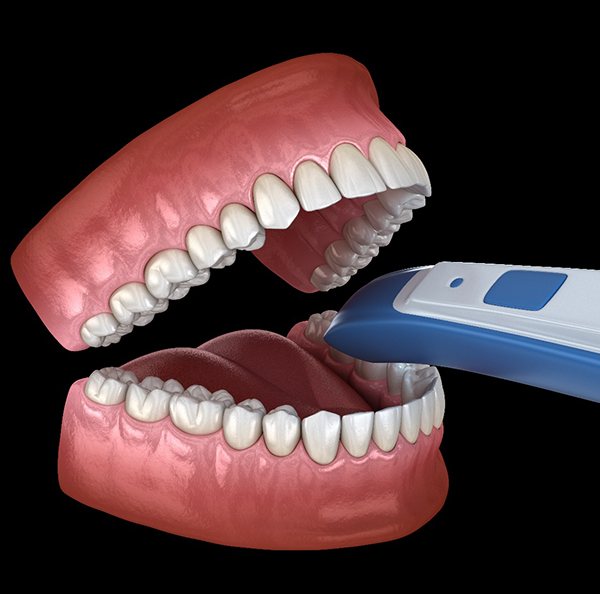 diagram of iTero scanner