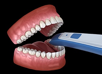 Intraoral scanning tool