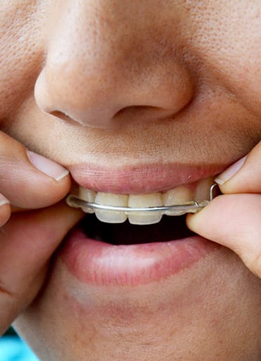 Closeup of patient placing retainer