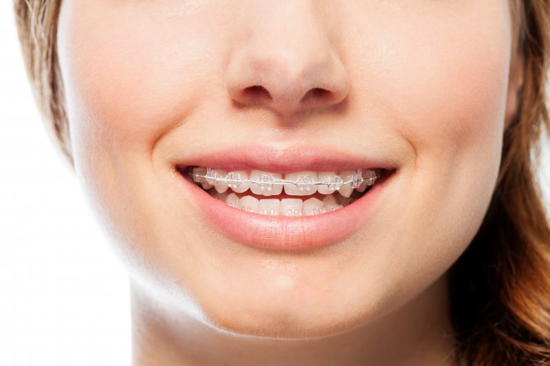 attractive woman smiling wearing braces
