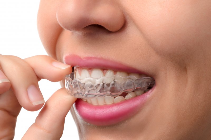 a set of Invisalign aligners