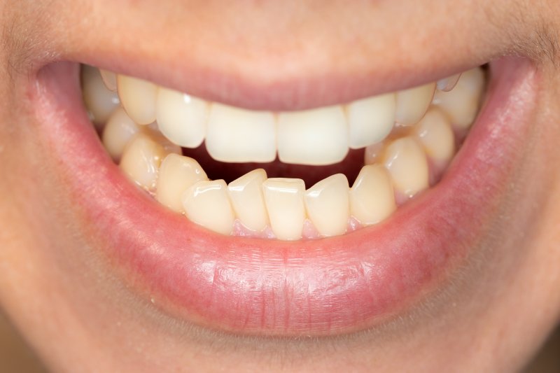 Misaligned teeth