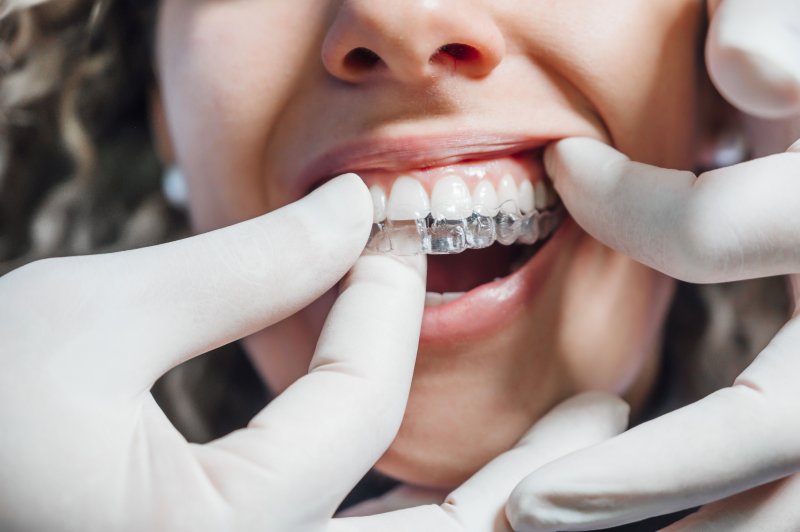 Closeup of woman getting Invisalign tray put on