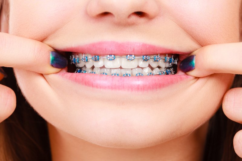 young woman showing her teeth with braces