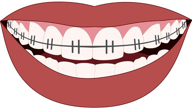 Image of a smile with metal braces.
