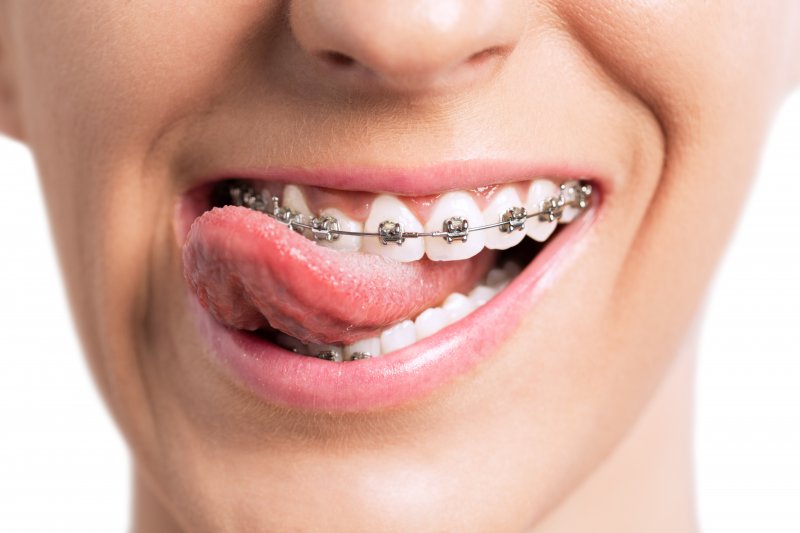 A close-up of a mouth with braces