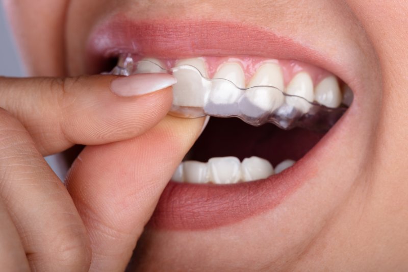 Close-up of someone putting on an aligner