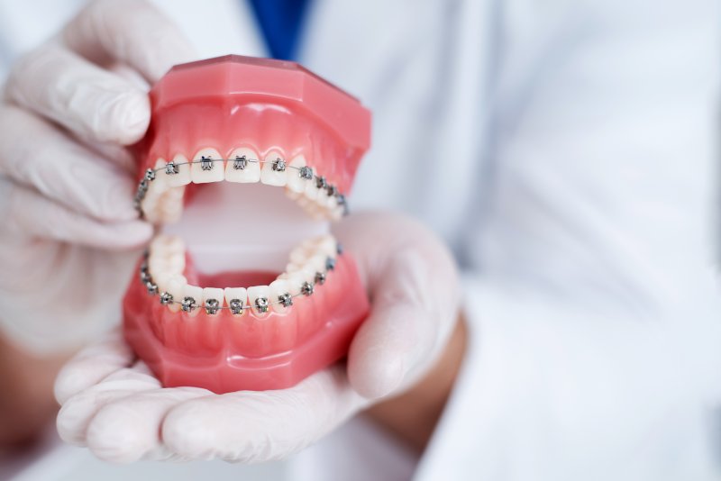 Dentist holding a model of a pair of teeth with braces