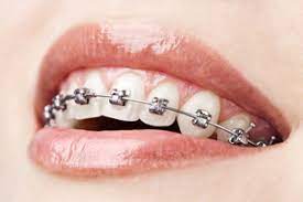 smiling adult with braces