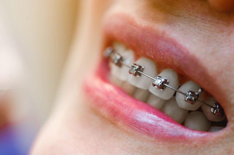 Teeth with braces