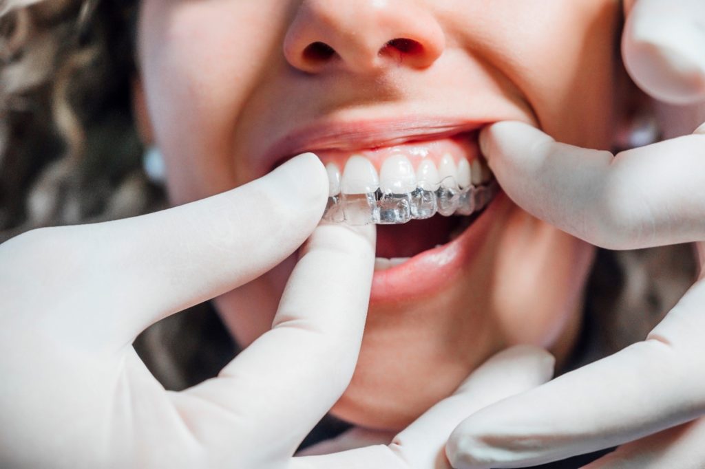 Closeup of dentist placing clear aligner on patient's teeth
